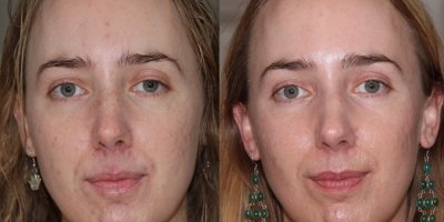 Acne en litteken behandeling fractionele laser en Zein Obagi