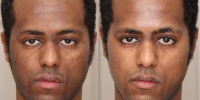 Gegeneraliseerde dyschromia en post-inflammatoire hyperpigmentatie
